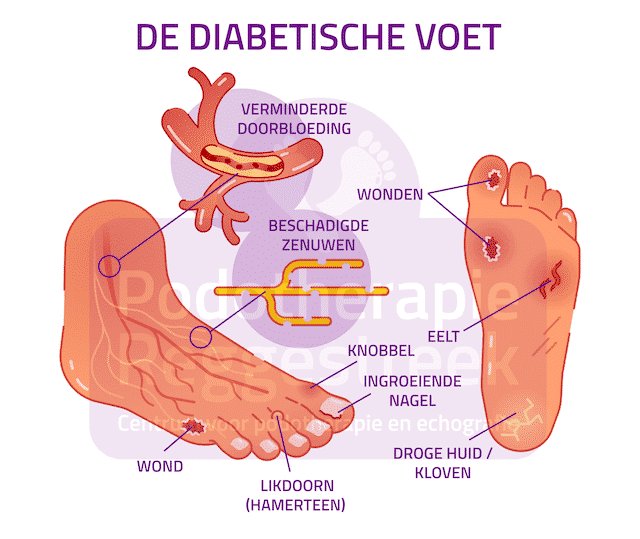 Pasen Regenachtig Defecte De diabetische voet | Podotherapie Reggestreek - Een stap vooruit!