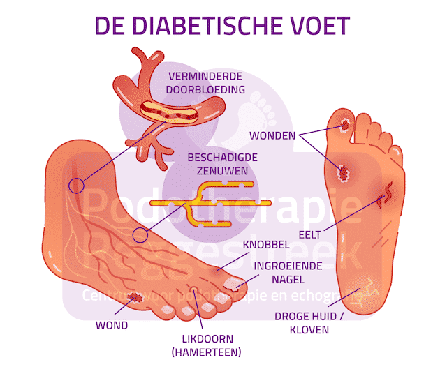 zorgmodule-preventie-voetulcera